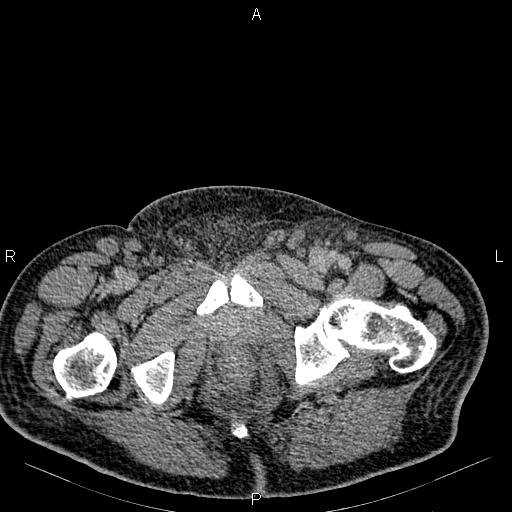 Non Hodgkin lymphoma in a patient with ankylosing spondylitis (Radiopaedia 84323-99621 Axial C+ delayed 86).jpg