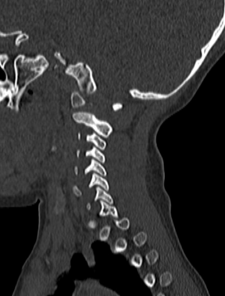 Normal CT cervical spine - pediatric (Radiopaedia 52549-58462 Sagittal bone window 160).jpg