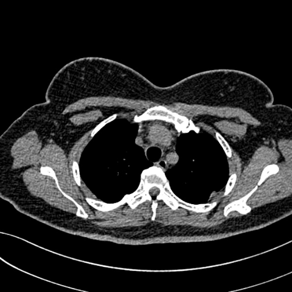 Normal CT chest- adult female (Radiopaedia 52522-58428 Axial non-contrast 33).jpg