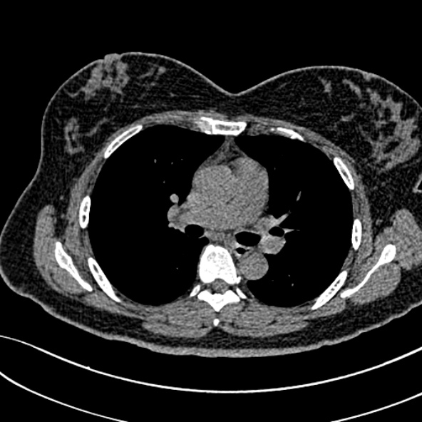 Normal CT chest- adult female (Radiopaedia 52522-58428 Axial non-contrast 59).jpg