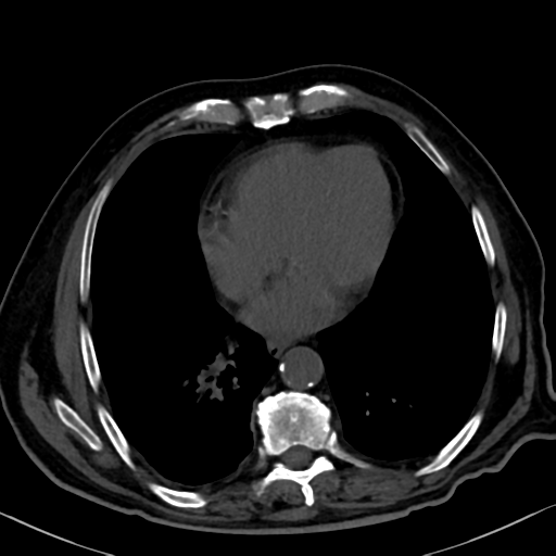 File:Normal CT intravenous cholangiogram (Radiopaedia 38199-40208 Axial IVC 5).png