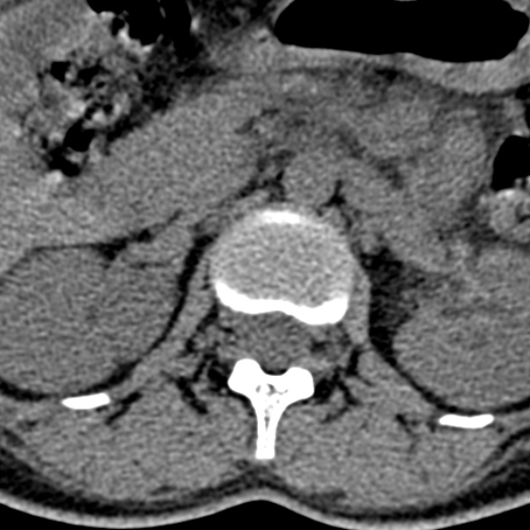 Normal CT lumbar spine (Radiopaedia 53981-60118 Axial non-contrast 23).jpg