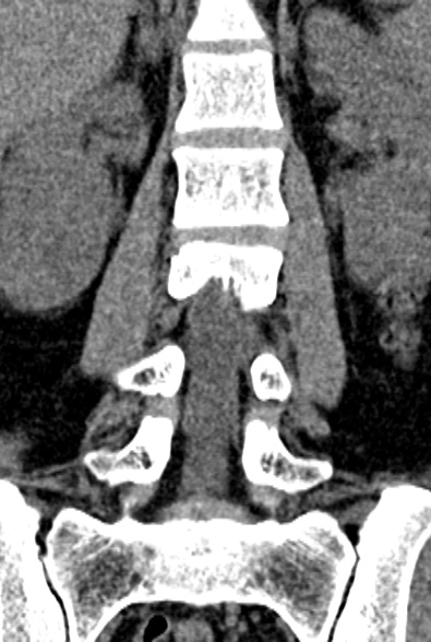 Normal CT lumbar spine (Radiopaedia 53981-60118 F 43).jpg