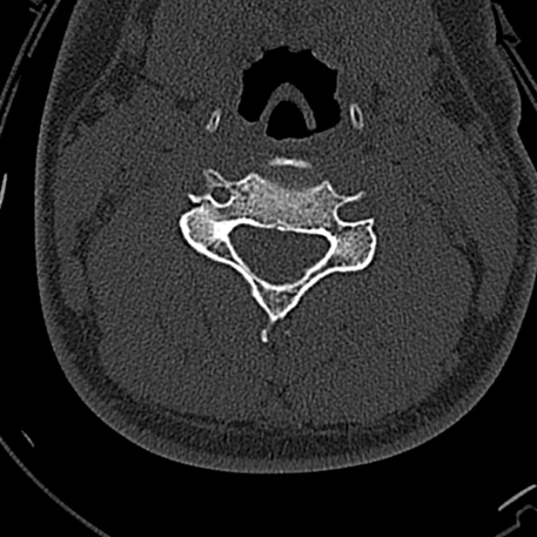 Normal CT of the cervical spine (Radiopaedia 53322-59305 Axial bone window 131).jpg
