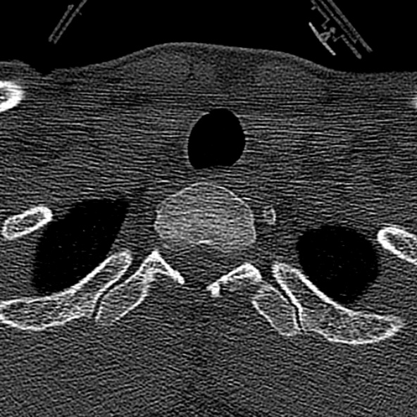 Normal CT of the cervical spine (Radiopaedia 53322-59305 Axial bone window 247).jpg