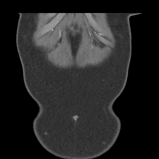 File:Normal CT renal artery angiogram (Radiopaedia 38727-40889 B 6).png