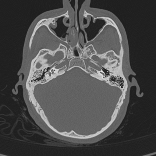 Normal CT skull (Radiopaedia 40798-43459 A 40).png