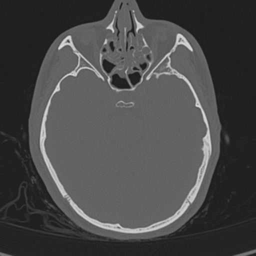 Normal CT skull (Radiopaedia 40798-43459 A 55).png