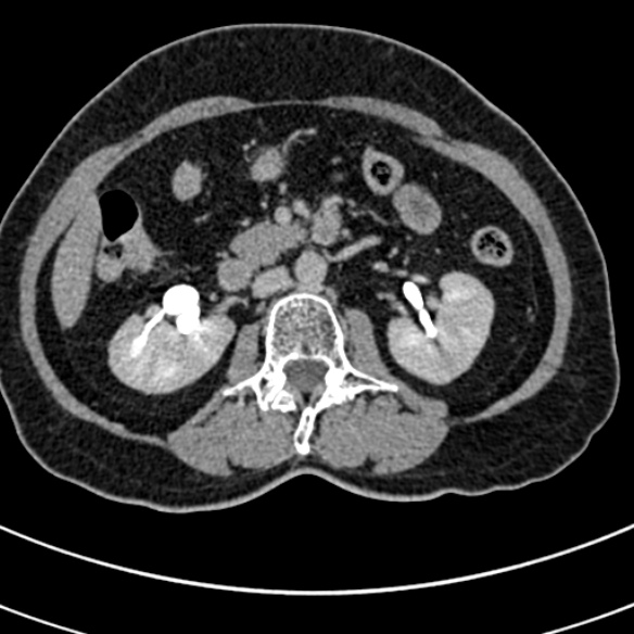File:Normal CT split bolus study of the renal tract (Radiopaedia 48631-53634 Axial split bolus 87).jpg