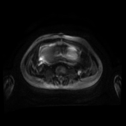 Normal MRI abdomen in pregnancy (Radiopaedia 88001-104541 Axial DWI 64).jpg