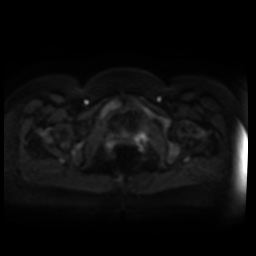 Normal MRI abdomen in pregnancy (Radiopaedia 88005-104548 Axial DWI 45).jpg