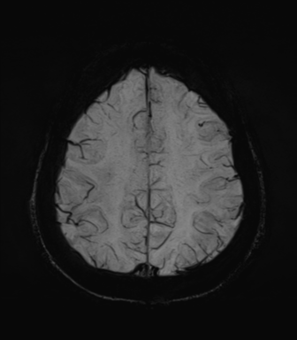Normal MRI internal auditory canal (Radiopaedia 41613-44525 Axial SWI MIP 61).png