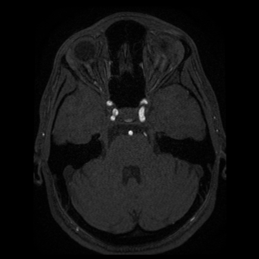 Normal brain MRA (Radiopaedia 41046-43793 Axial MRA 75).png