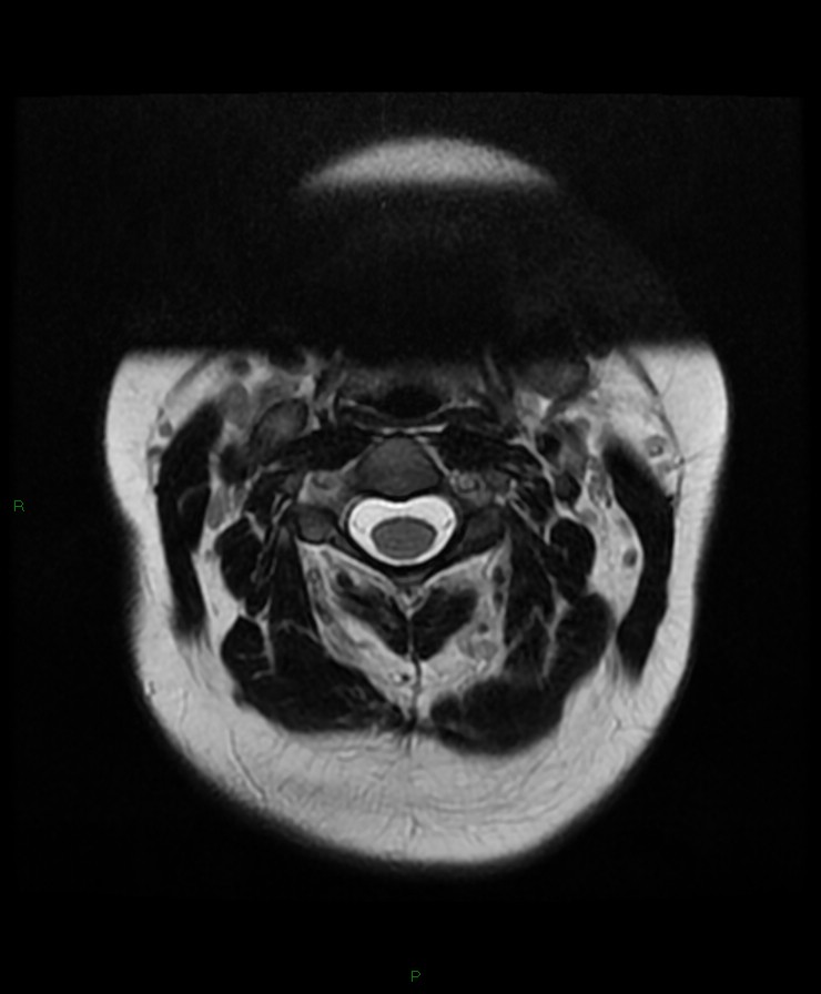 Normal cervical spine MRI (Radiopaedia 80146-93454 Axial T2 21).jpg