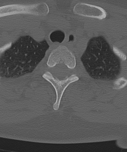 Normal cervical spine MRI (including Dixon) (Radiopaedia 42762-45926 Axial bone window 56).png