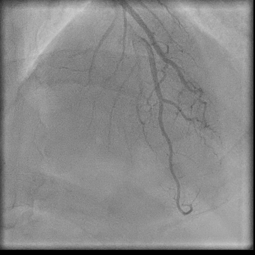Normal coronary angiogram (DSA) (Radiopaedia 63081-71571 E 67).jpg