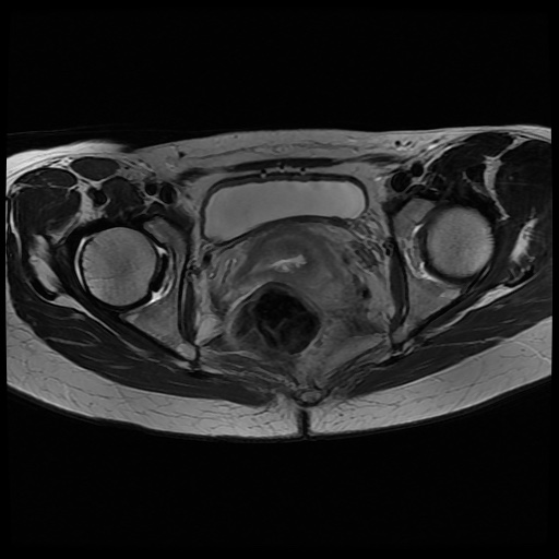 File:Normal female pelvis MRI (retroverted uterus) (Radiopaedia 61832-69933 Axial T2 21).jpg