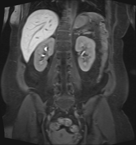 File:Normal hepatobiliary phase liver MRI (Radiopaedia 58968-66230 B 17).jpg