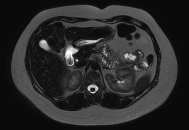 File:Normal liver MRI with Gadolinium (Radiopaedia 58913-66163 E 17).jpg