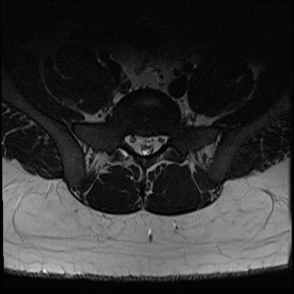 File:Normal lumbar spine MRI (Radiopaedia 47857-52609 Axial T2 29).jpg