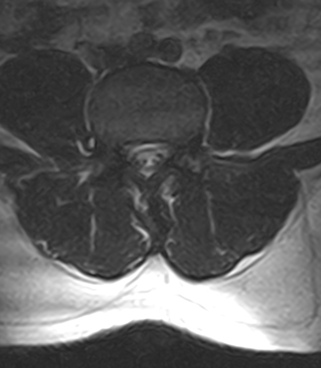 Normal lumbar spine MRI - low-field MRI scanner (Radiopaedia 40976-43699 Axial T2 66).jpg