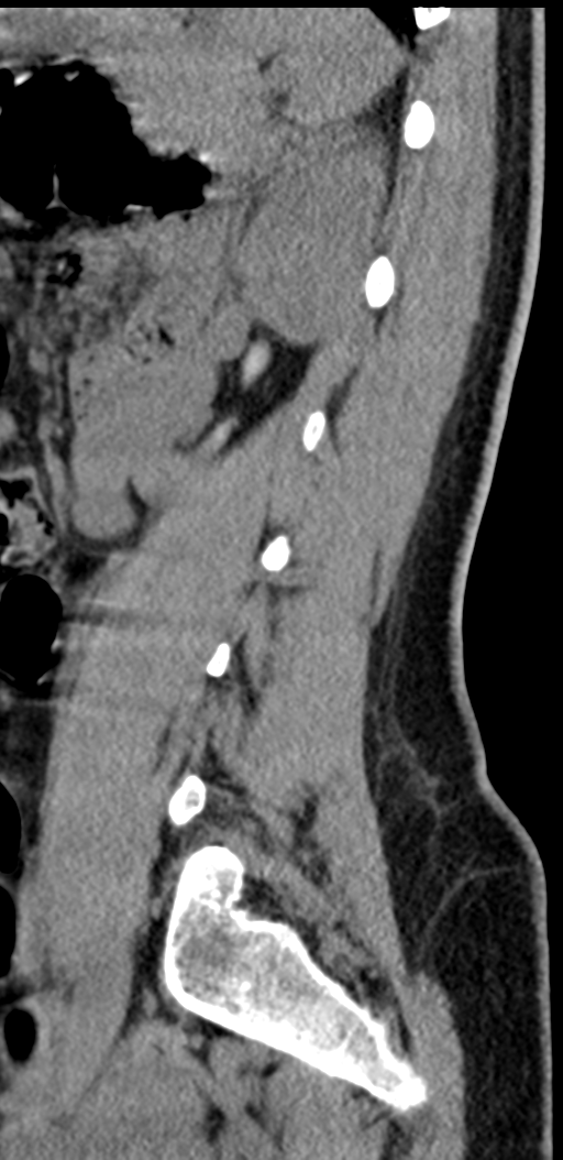 Normal lumbosacral CT (Radiopaedia 37923-39867 E 32).png