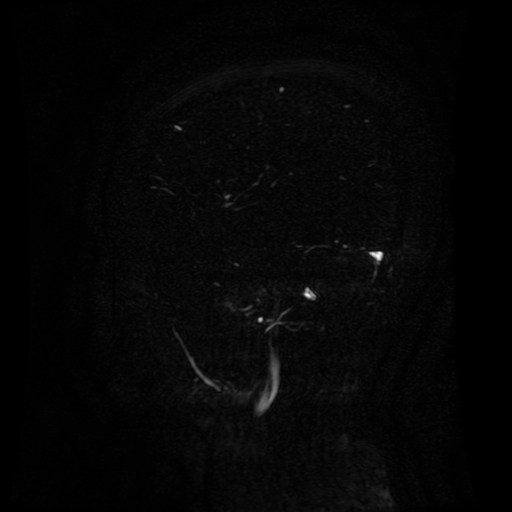 Normal noncontrast MR venography (Radiopaedia 87578-103957 A 135).jpg