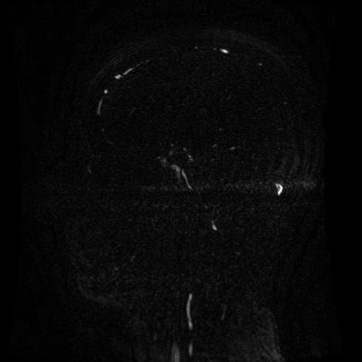 Normal noncontrast MR venography (Radiopaedia 87578-103957 A 71).jpg