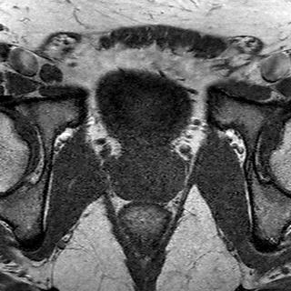 File:Normal prostate (MRI) (Radiopaedia 29986-30535 Axial T1 10).jpg