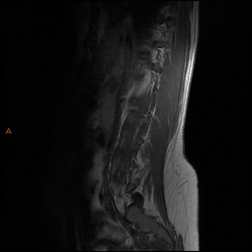 File:Normal spine MRI (Radiopaedia 77323-89408 Sagittal T1 3).jpg