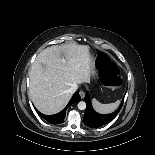 Obstructing sigmoid adenocarcinoma (Radiopaedia 58465-65619 A 28).jpg