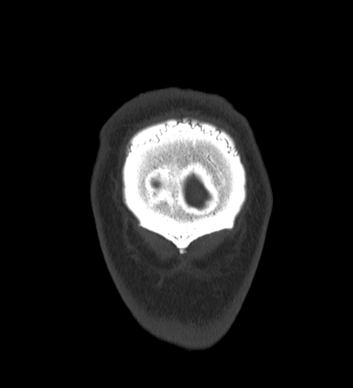 Occipital spur and Currarino type A atlas anomaly (Radiopaedia 87027-103285 Coronal bone window 142).jpg
