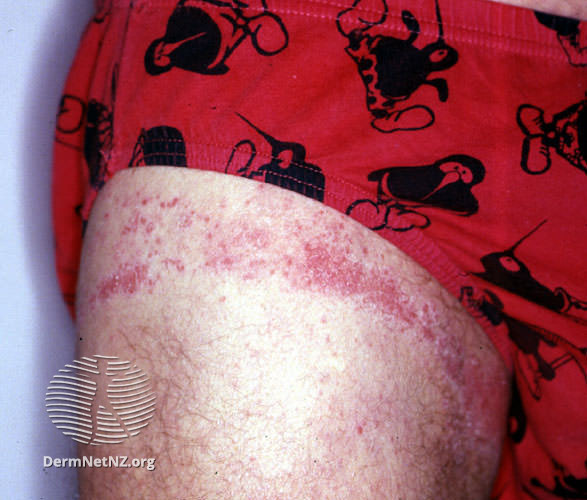 File:Rubber dermatitis (DermNet NZ dermatitis-acd-pants).jpg