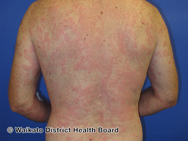 File:Urticaria (DermNet NZ systemic-w-itchy-skin-67).jpg