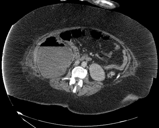 File:Abdominal abscess - pre and post percutaneous drainage (Radiopaedia 60209-67816 Axial 7).png