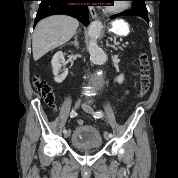 File:Abdominal aortic aneurysm (Radiopaedia 10122-10660 Coronal C+ portal venous phase 26).jpg