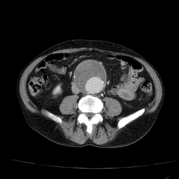 Abdominal aortic aneurysm (Radiopaedia 29248-29660 Axial C+ portal venous phase 36).jpg