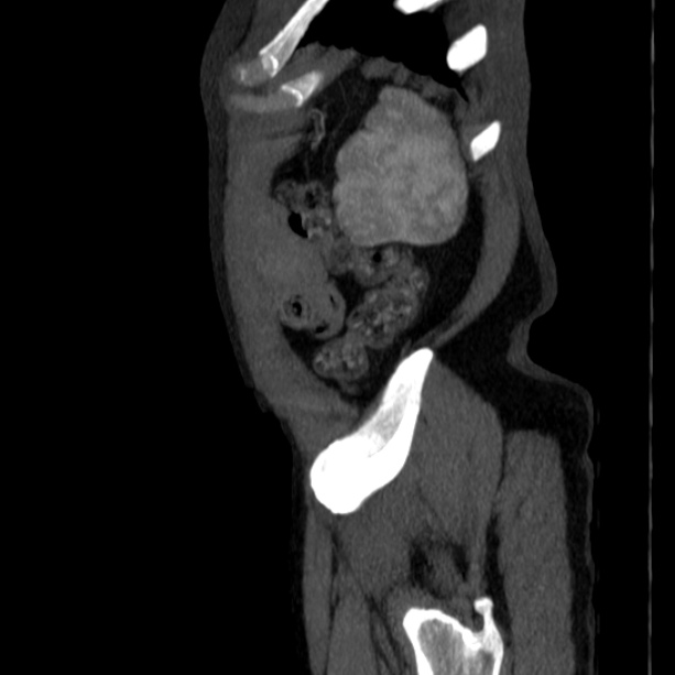 Abdominal aortic aneurysm (Radiopaedia 29248-29660 Sagittal C+ arterial phase 52).jpg