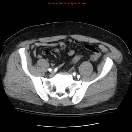 File:Abdominal aortic aneurysm (Radiopaedia 8190-9038 Axial C+ arterial phase 63).jpg