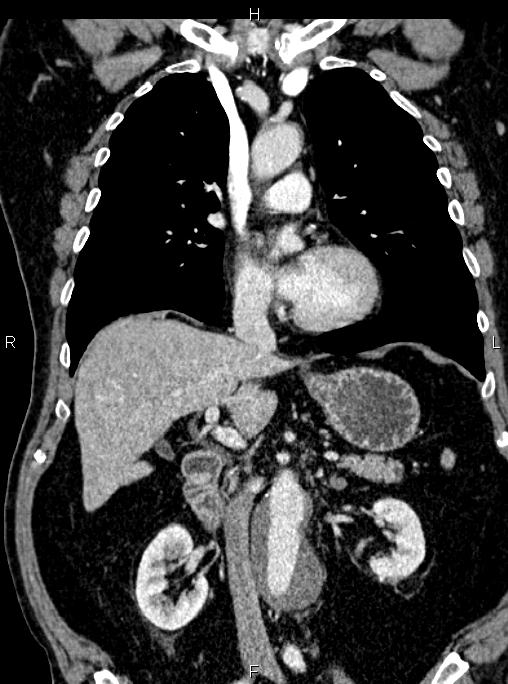 Abdominal aortic aneurysm (Radiopaedia 83094-97462 Coronal renal cortical phase 46).jpg