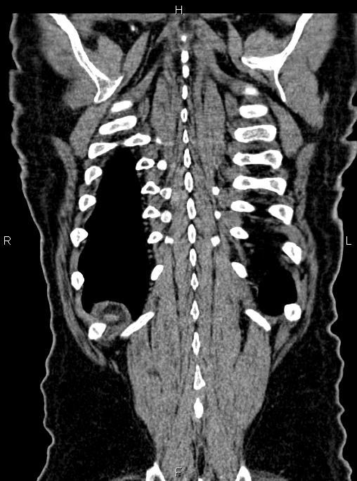 Abdominal aortic aneurysm (Radiopaedia 83094-97462 Coronal renal cortical phase 82).jpg