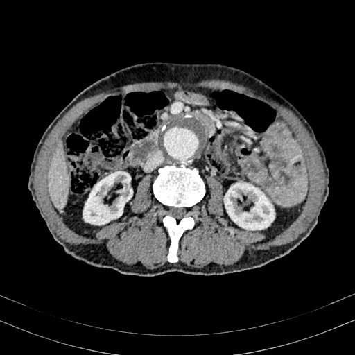 Abdominal aortic aneurysm (Radiopaedia 83581-98689 Axial C+ portal venous phase 56).jpg