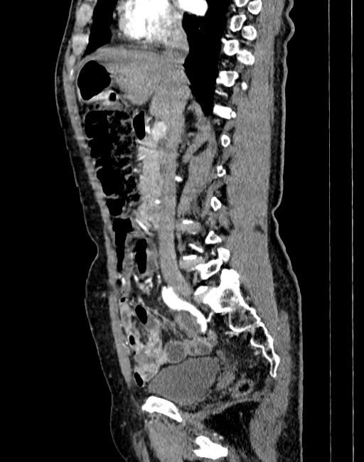 Abdominal aortic aneurysm (Radiopaedia 83581-98689 Sagittal C+ arterial phase 25).jpg