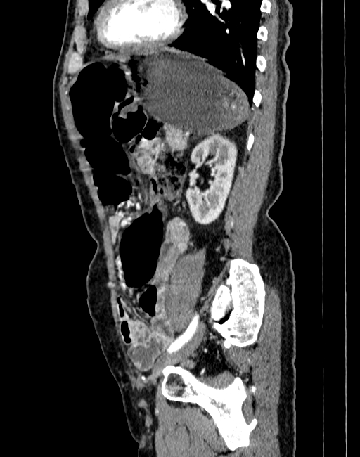 Abdominal aortic aneurysm (Radiopaedia 83581-98689 Sagittal C+ arterial phase 83).jpg
