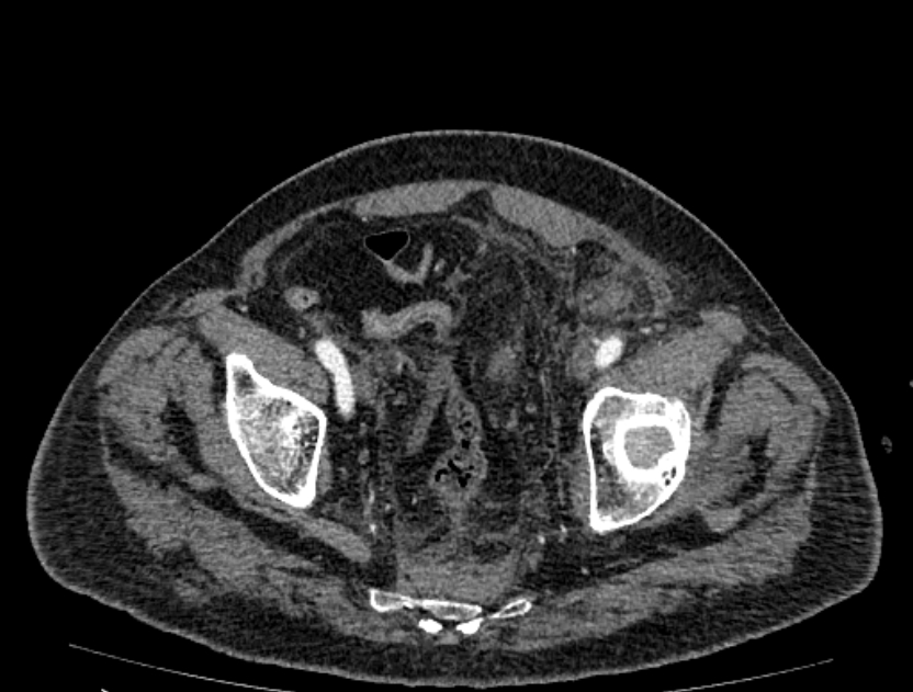 Abdominal aortic aneurysm rupture (Radiopaedia 54179-60362 Axial C+ portal venous phase 3).jpg