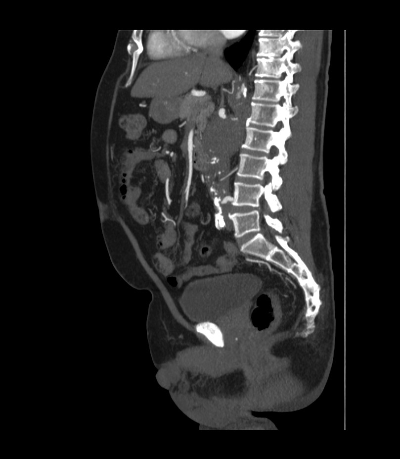 Abdominal aortic aneurysm with thrombus fissuration (Radiopaedia 46218-50618 Sagittal C+ arterial phase 29).jpg