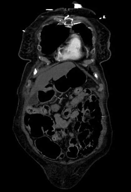 Abdominal aortic aneurysm with thrombus fissuration (Radiopaedia 73192-83919 Coronal C+ arterial phase 5).jpg