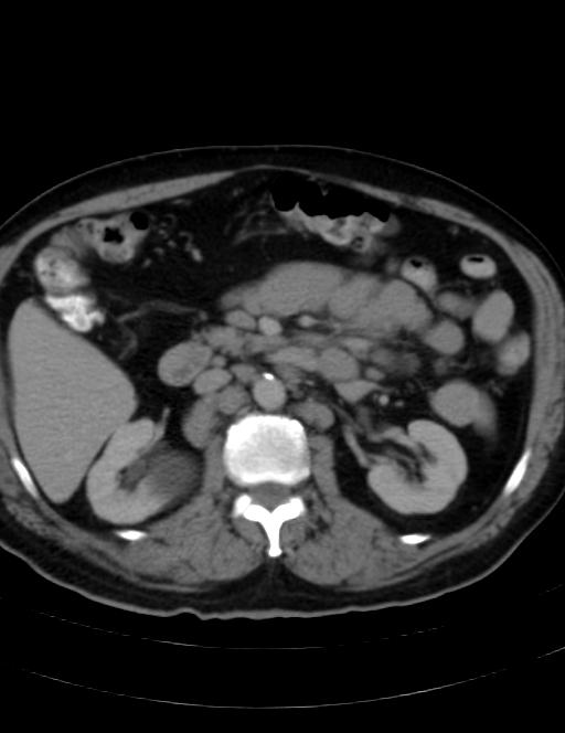 Abdominal lymphoma - with sandwich sign (Radiopaedia 53486-59492 Axial C+ portal venous phase 21).jpg