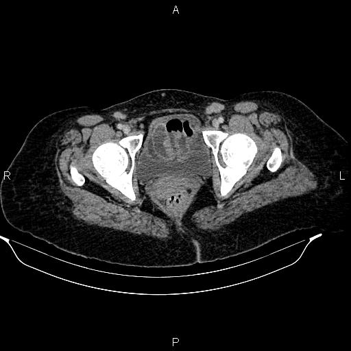Abdominal lymphoma with sandwich sign (Radiopaedia 84378-99704 Axial C+ portal venous phase 56).jpg