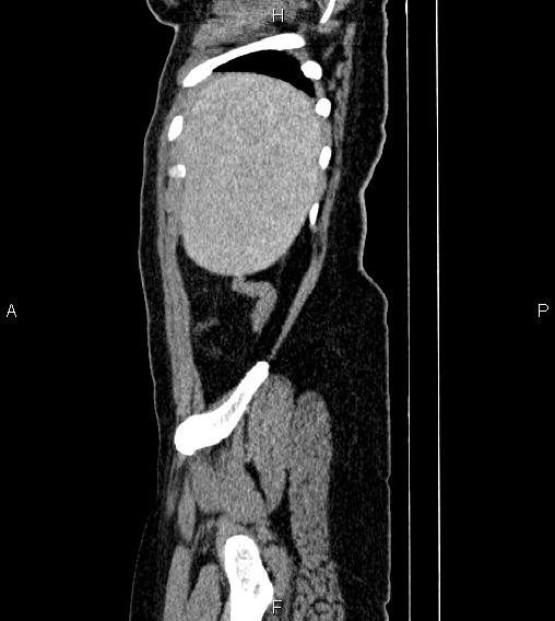 File:Abdominal lymphoma with sandwich sign (Radiopaedia 84378-99704 Sagittal C+ portal venous phase 85).jpg